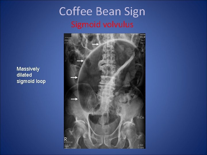 Coffee Bean Sigmoid volvulus Massively dilated sigmoid loop 