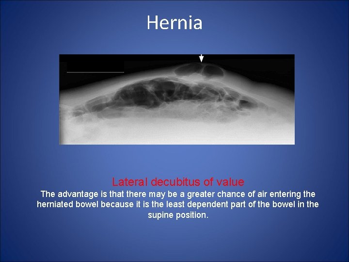 Hernia Lateral decubitus of value The advantage is that there may be a greater