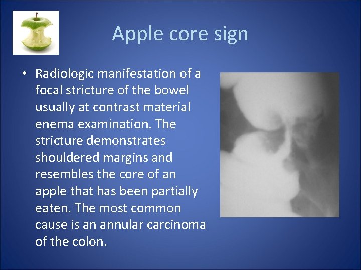 Apple core sign • Radiologic manifestation of a focal stricture of the bowel usually