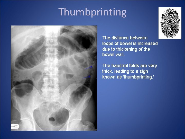 Thumbprinting The distance between loops of bowel is increased due to thickening of the