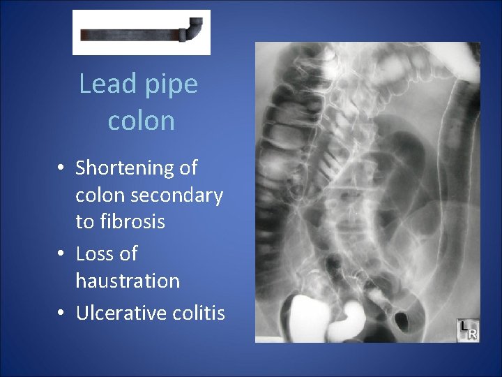 Lead pipe colon • Shortening of colon secondary to fibrosis • Loss of haustration