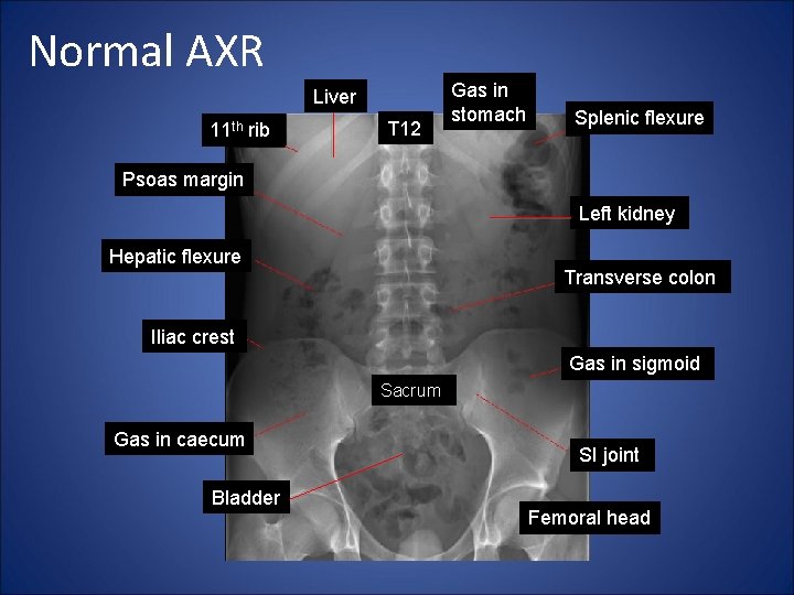 Normal AXR Liver 11 th rib T 12 Gas in stomach Splenic flexure Psoas