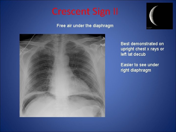 Crescent Sign II Free air under the diaphragm Best demonstrated on upright chest x