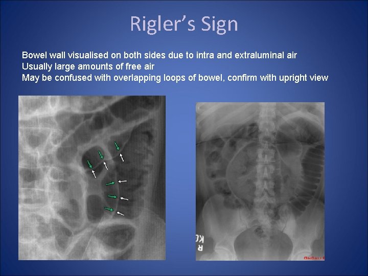 Rigler’s Sign Bowel wall visualised on both sides due to intra and extraluminal air