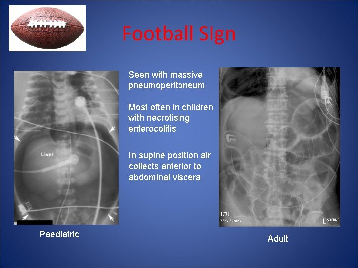 Football SIgn Seen with massive pneumoperitoneum Most often in children with necrotising enterocolitis In