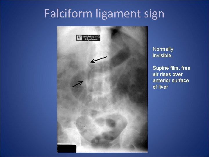 Falciform ligament sign Normally invisible. Supine film, free air rises over anterior surface of