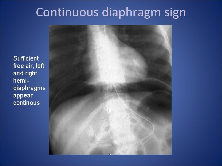 Continuous diaphragm sign Sufficient free air, left and right hemidiaphragms appear continous 