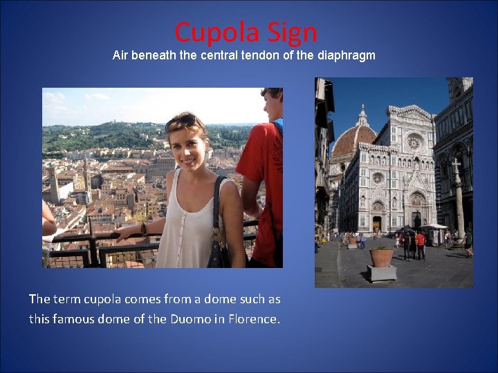 Cupola Sign Air beneath the central tendon of the diaphragm The term cupola comes