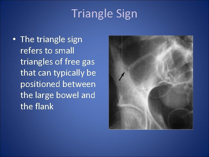 Triangle Sign • The triangle sign refers to small triangles of free gas that