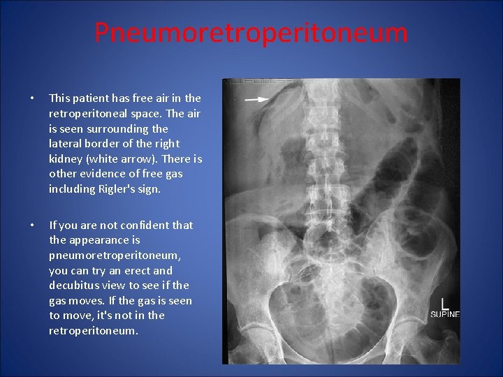 Pneumoretroperitoneum • This patient has free air in the retroperitoneal space. The air is