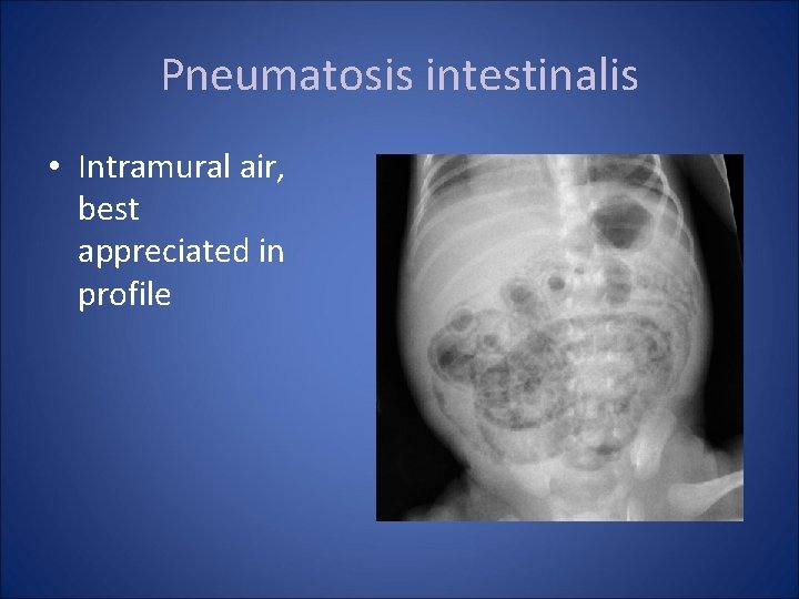 Pneumatosis intestinalis • Intramural air, best appreciated in profile 