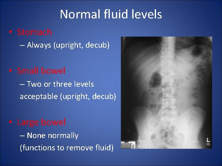 Normal fluid levels • Stomach – Always (upright, decub) • Small bowel – Two