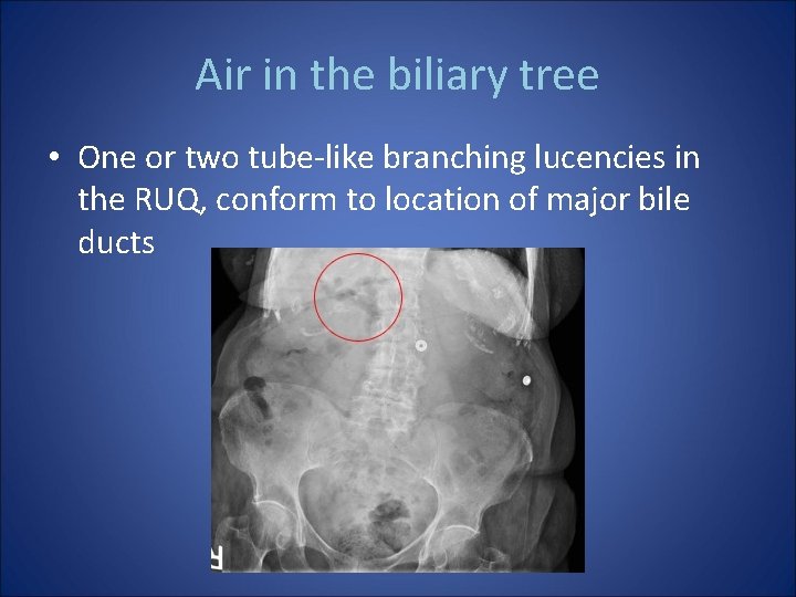 Air in the biliary tree • One or two tube-like branching lucencies in the