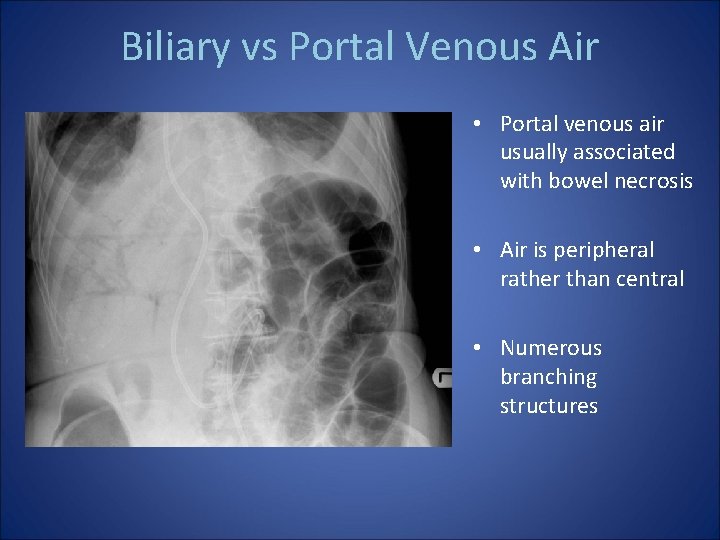 Biliary vs Portal Venous Air • Portal venous air usually associated with bowel necrosis