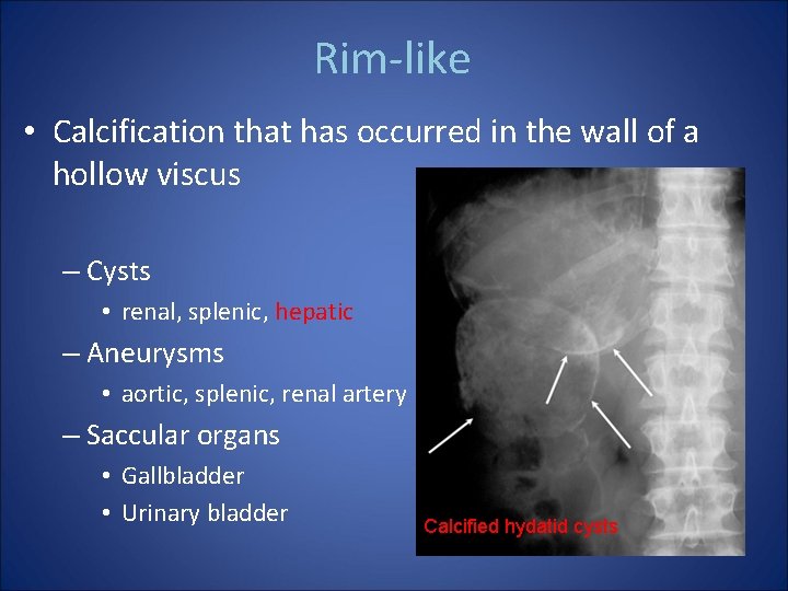 Rim-like • Calcification that has occurred in the wall of a hollow viscus –