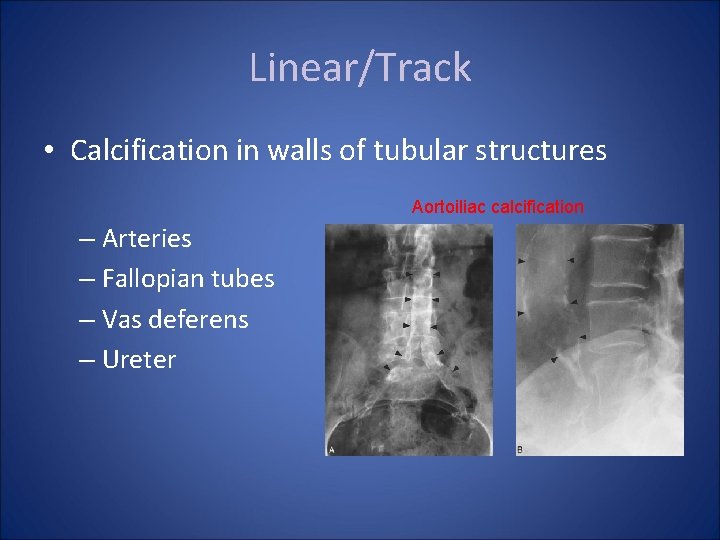 Linear/Track • Calcification in walls of tubular structures Aortoiliac calcification – Arteries – Fallopian