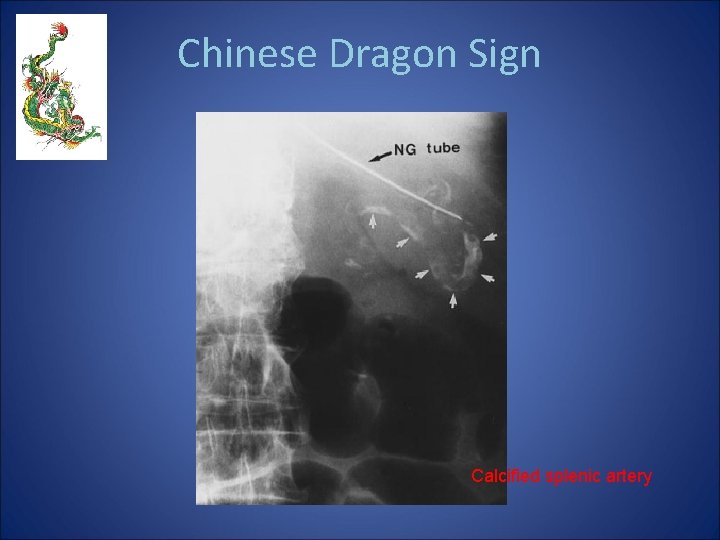 Chinese Dragon Sign Calcified splenic artery 