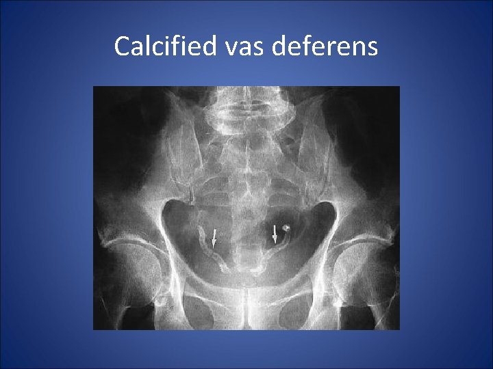 Calcified vas deferens 
