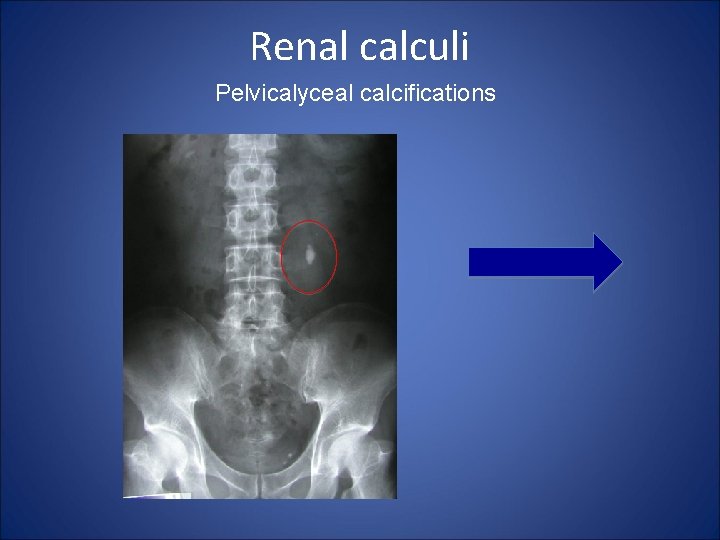 Renal calculi Pelvicalyceal calcifications 