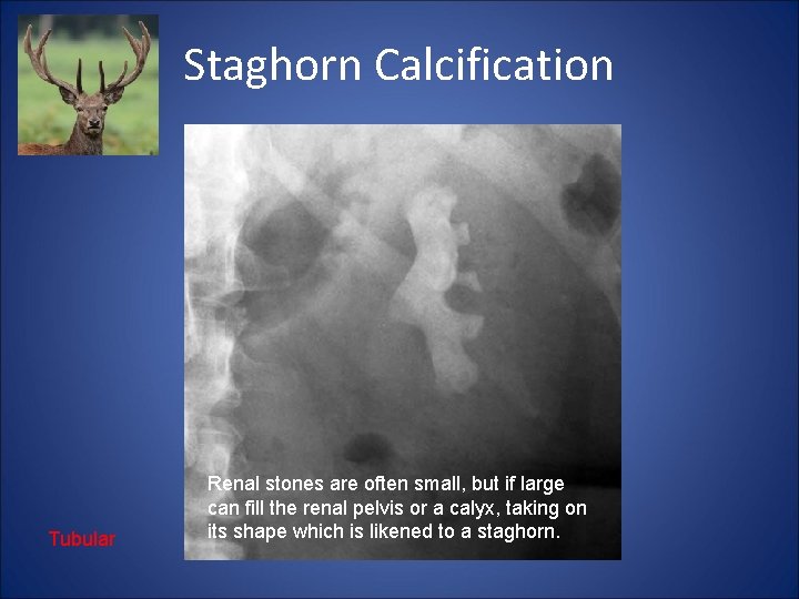 Staghorn Calcification Tubular Renal stones are often small, but if large can fill the