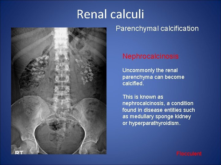 Renal calculi Parenchymal calcification Nephrocalcinosis Uncommonly the renal parenchyma can become calcified. This is
