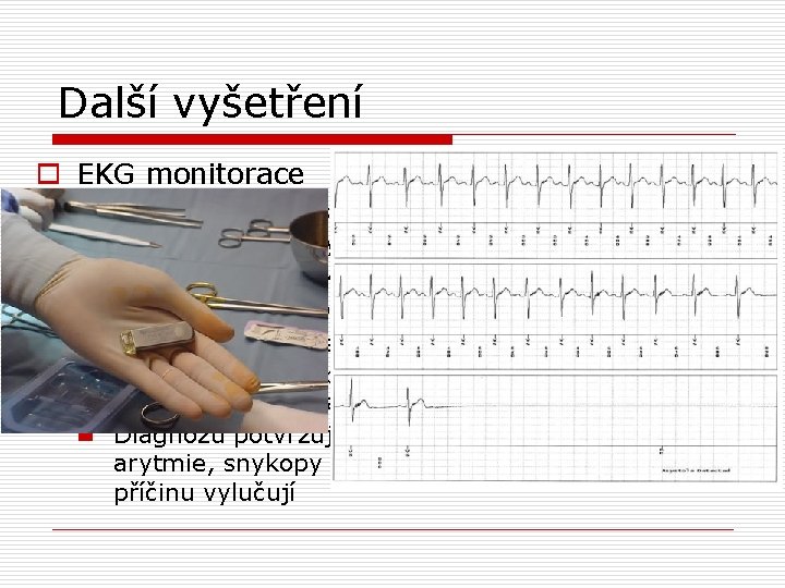 Další vyšetření o EKG monitorace n Monitorace za hospitaliazce o Suspekce na artymickou příčinu,