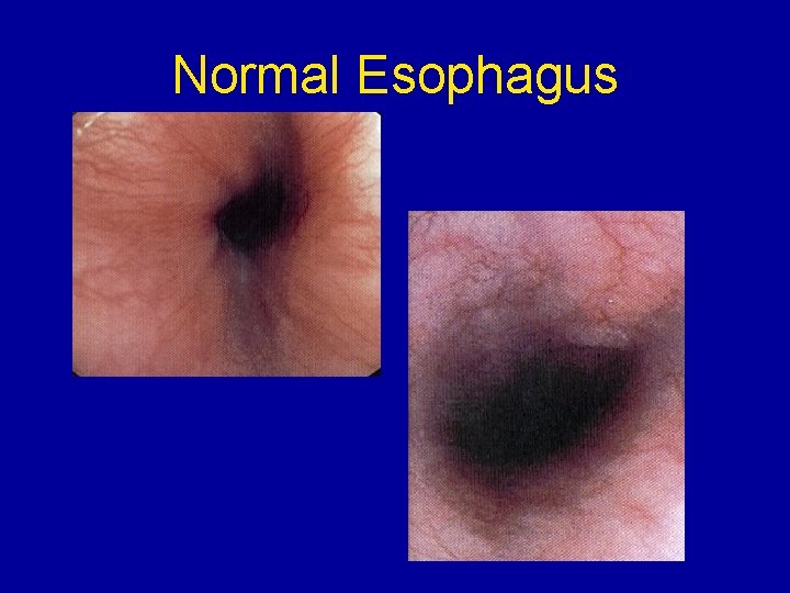 Normal Esophagus 