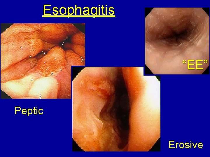 Esophagitis “EE” Peptic Erosive 