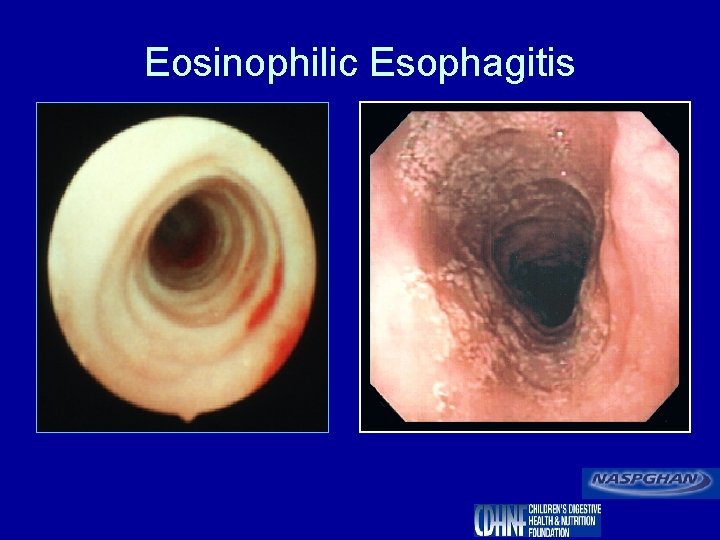 Eosinophilic Esophagitis 