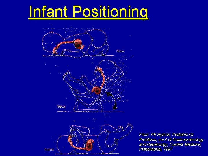 Infant Positioning From: PE Hyman, Pediatric GI Problems, vol 4 of Gastroenterology and Hepatology,