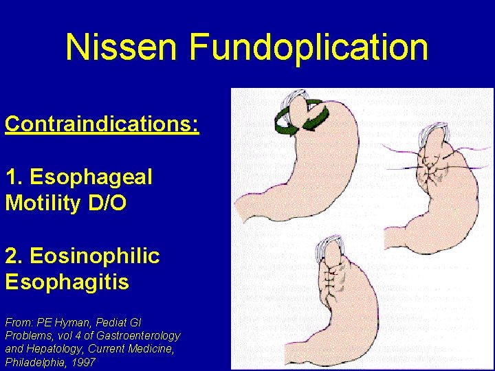Nissen Fundoplication Contraindications: 1. Esophageal Motility D/O 2. Eosinophilic Esophagitis From: PE Hyman, Pediat
