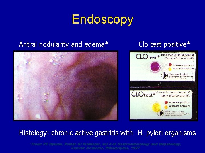 Endoscopy Antral nodularity and edema* Clo test positive* Histology: chronic active gastritis with H.