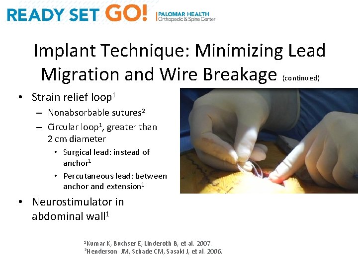Implant Technique: Minimizing Lead Migration and Wire Breakage (continued) • Strain relief loop 1