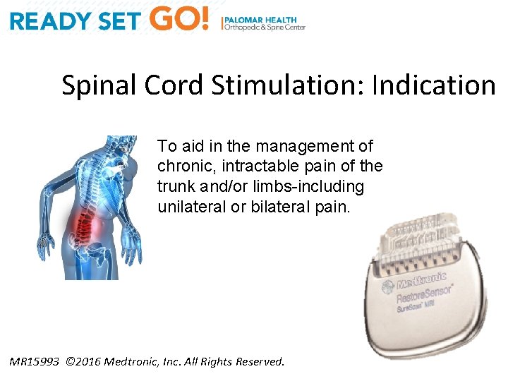 Spinal Cord Stimulation: Indication To aid in the management of chronic, intractable pain of