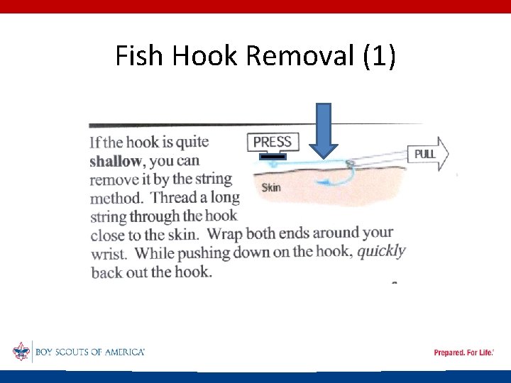 Fish Hook Removal (1) 