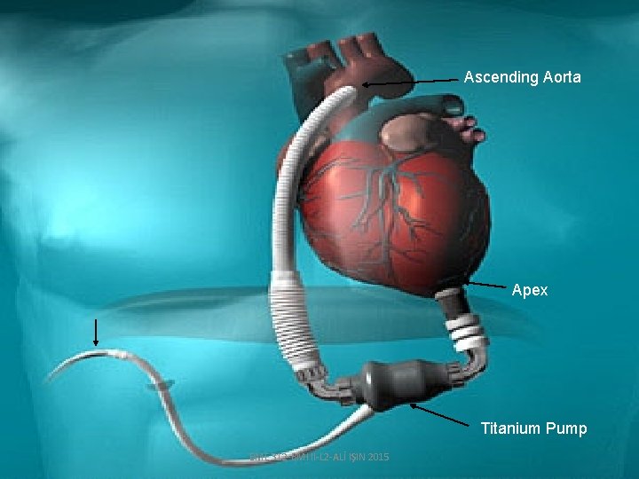 Ascending Aorta Apex Titanium Pump BME 312 -BMI II-L 2 -ALİ IŞIN 2015 