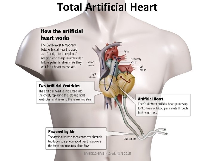 Total Artificial Heart BME 312 -BMI II-L 2 -ALİ IŞIN 2015 