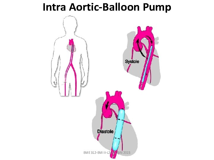 Intra Aortic-Balloon Pump BME 312 -BMI II-L 2 -ALİ IŞIN 2015 