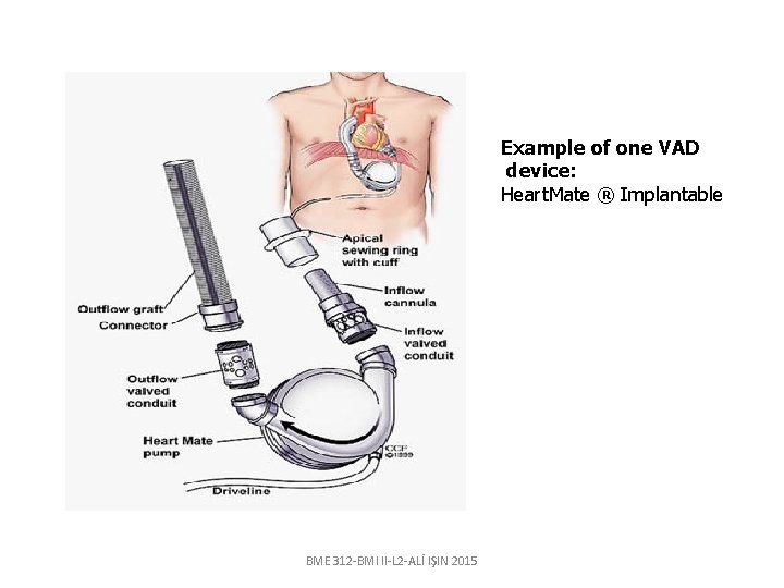 Example of one VAD device: Heart. Mate ® Implantable BME 312 -BMI II-L 2