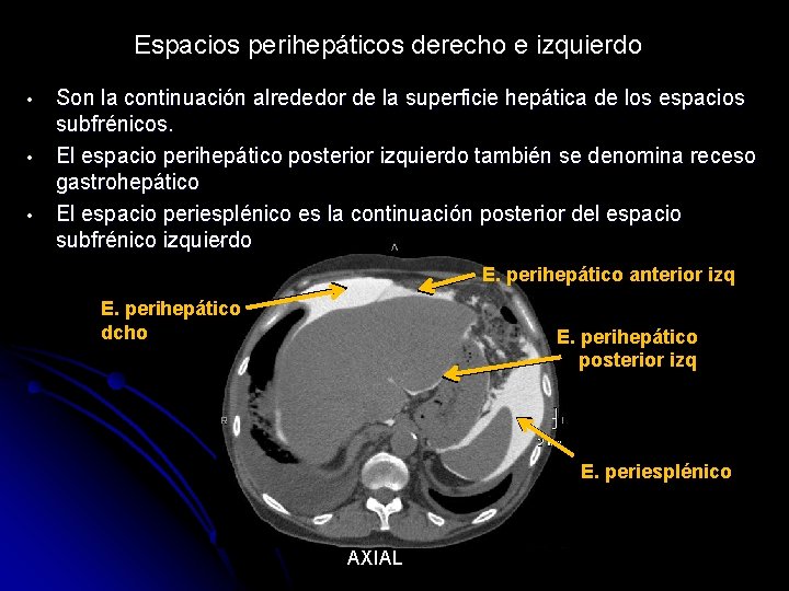 Espacios perihepáticos derecho e izquierdo • • • Son la continuación alrededor de la