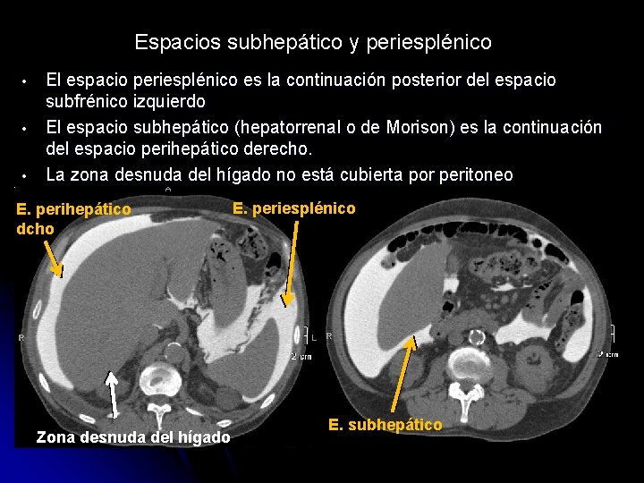 Espacios subhepático y periesplénico • • • El espacio periesplénico es la continuación posterior