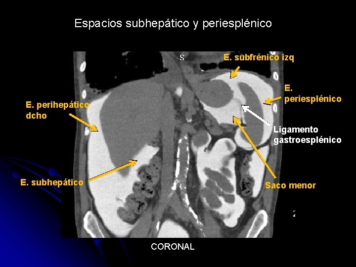 Espacios subhepático y periesplénico E. subfrénico izq E. periesplénico E. perihepático dcho Ligamento gastroesplénico