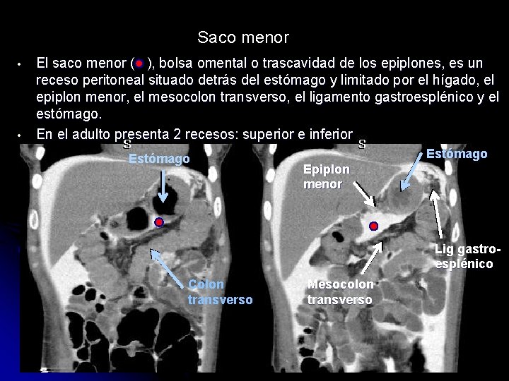 Saco menor • • El saco menor ( ), bolsa omental o trascavidad de
