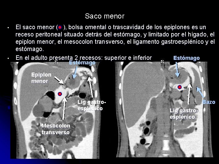 Saco menor • • El saco menor ( ), bolsa omental o trascavidad de