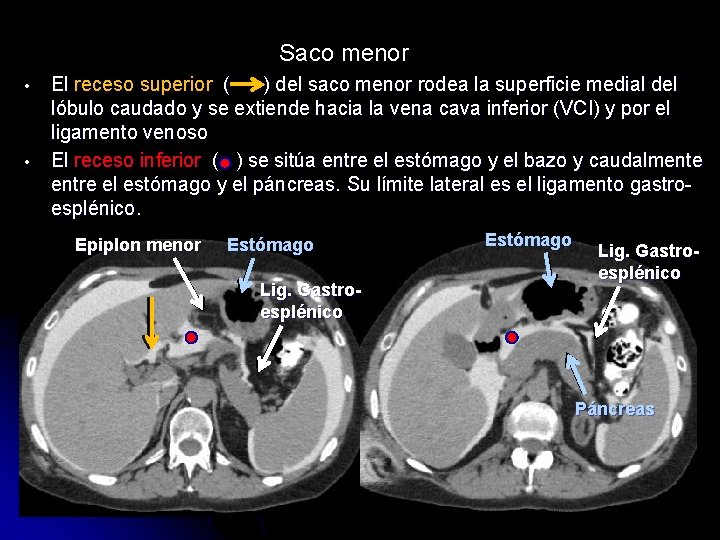 Saco menor • • El receso superior ( ) del saco menor rodea la