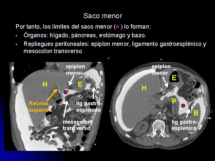 Saco menor Por tanto, los límites del saco menor ( ) lo forman: •
