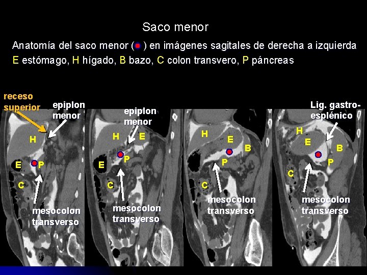 Saco menor Anatomía del saco menor ( ) en imágenes sagitales de derecha a
