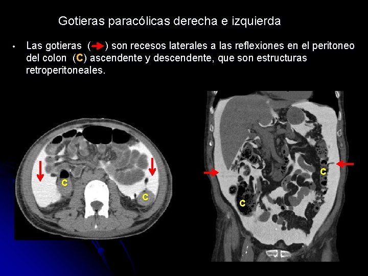 Gotieras paracólicas derecha e izquierda • Las gotieras ( ) son recesos laterales a