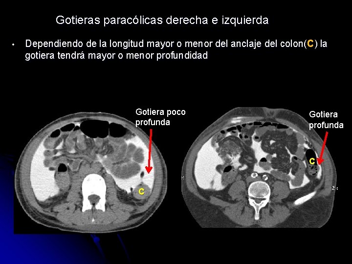 Gotieras paracólicas derecha e izquierda • Dependiendo de la longitud mayor o menor del
