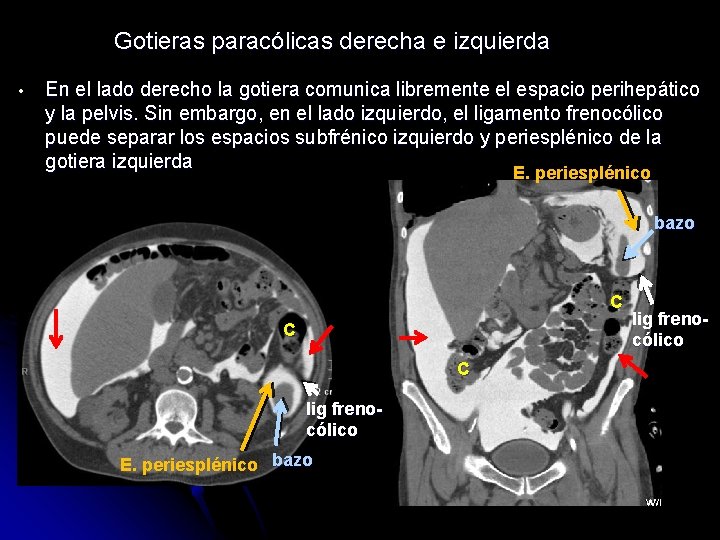Gotieras paracólicas derecha e izquierda • En el lado derecho la gotiera comunica libremente